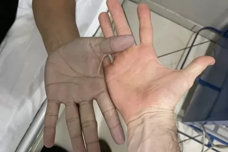 Un médico atendió a un joven con las manos azules: Este fue el diagnóstico