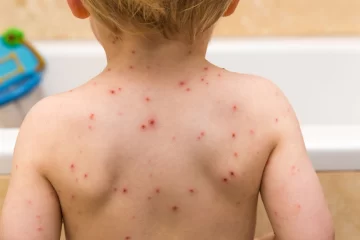 Alerta en las escuelas por casos de varicela