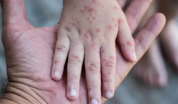 La OMS advirtió sobre el crecimiento de los casos de sarampión en el mundo