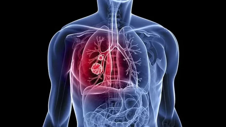 Presentan en Argentina un nuevo tratamiento para un tipo de cáncer de pulmón