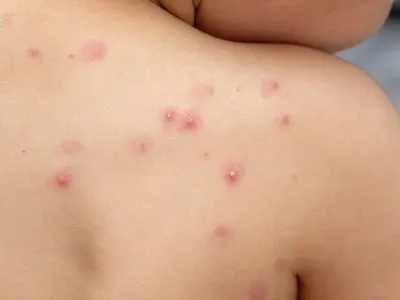 Descartan un posible caso de viruela del mono en Tucumán Descartan un posible caso de viruela del mono en Tucumán