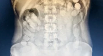 Detuvieron a una mujer que transportaba 106 cápsulas de cocaína en el estómago Detuvieron a una mujer que transportaba 106 cápsulas de cocaína en el estómago