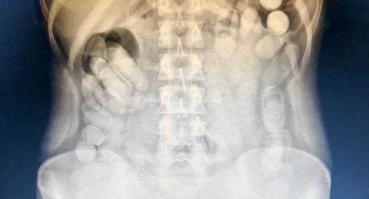 Detuvieron a una mujer que transportaba 106 cápsulas de cocaína en el estómago Detuvieron a una mujer que transportaba 106 cápsulas de cocaína en el estómago