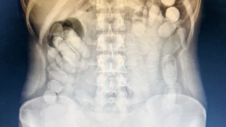 Detuvieron a una mujer que transportaba 106 cápsulas de cocaína en el estómago